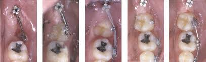 molar series