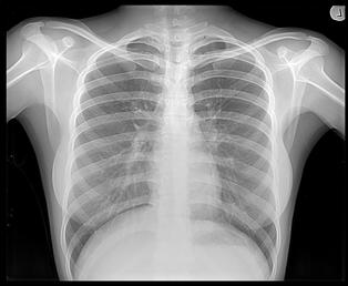 X-ray Chest